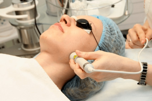 Laserbiorevitaliseerimine