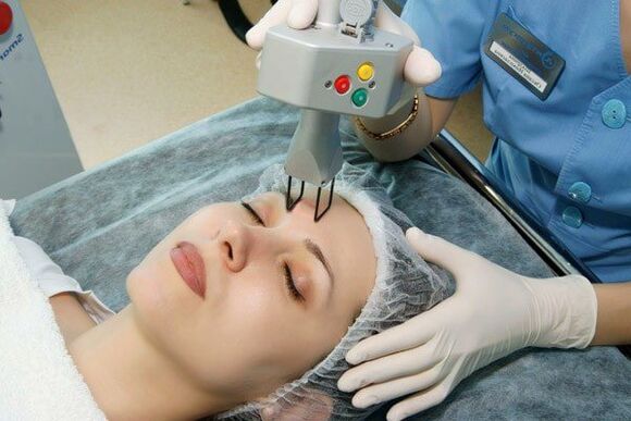 Laser noorendamine