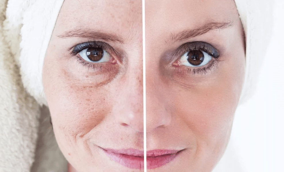 laser näo noorendamine